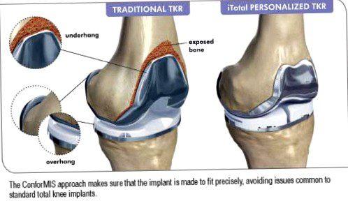 10 valuable tips for successful implantation of a challenging total knee prosthesis